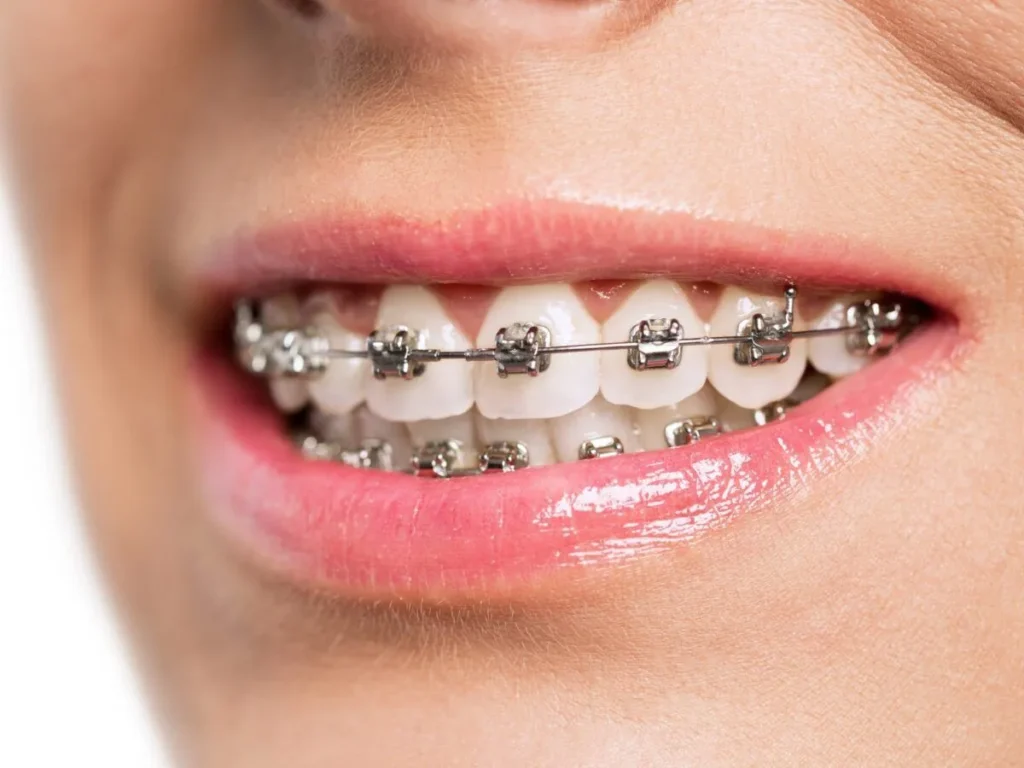 What are the functions of different post-orthodontic retainers